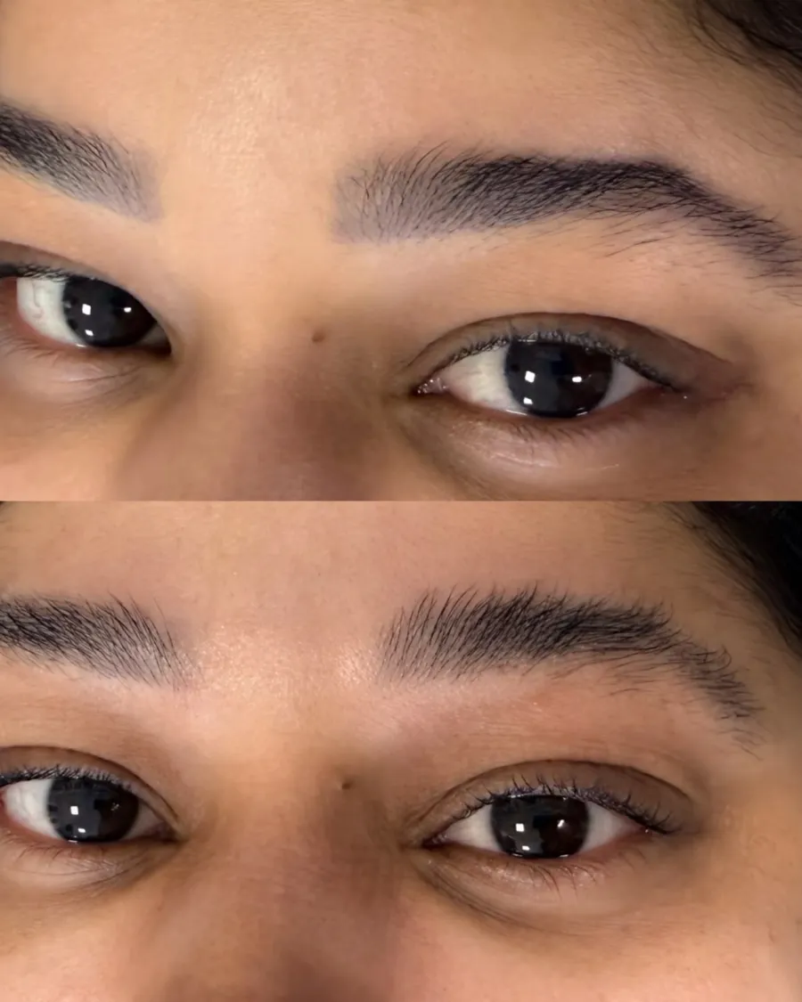 Antes e depois da remoção de micropigmentação de sobrancelhas: acima, pigmento acinzentado; abaixo, sobrancelhas naturais após o tratamento