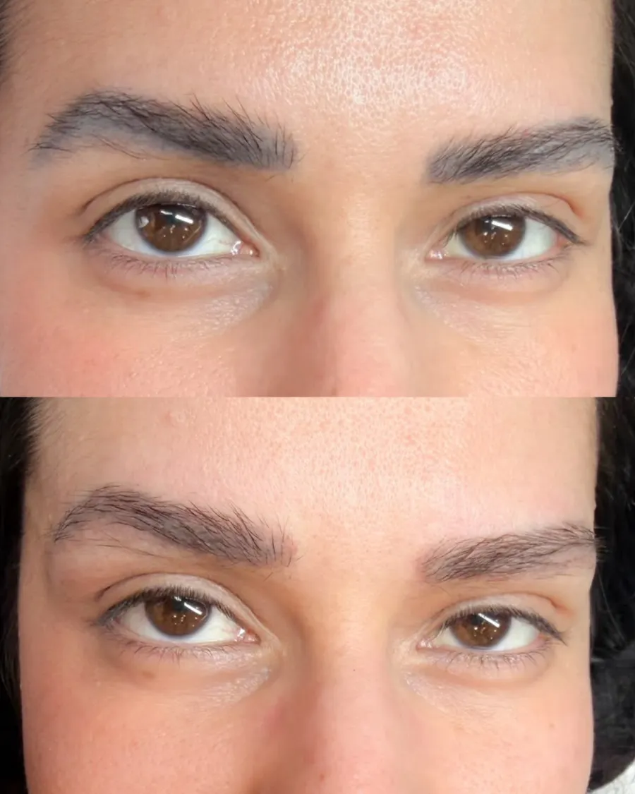 Antes e depois da remoção de micropigmentação de sobrancelhas, com redução do pigmento escuro