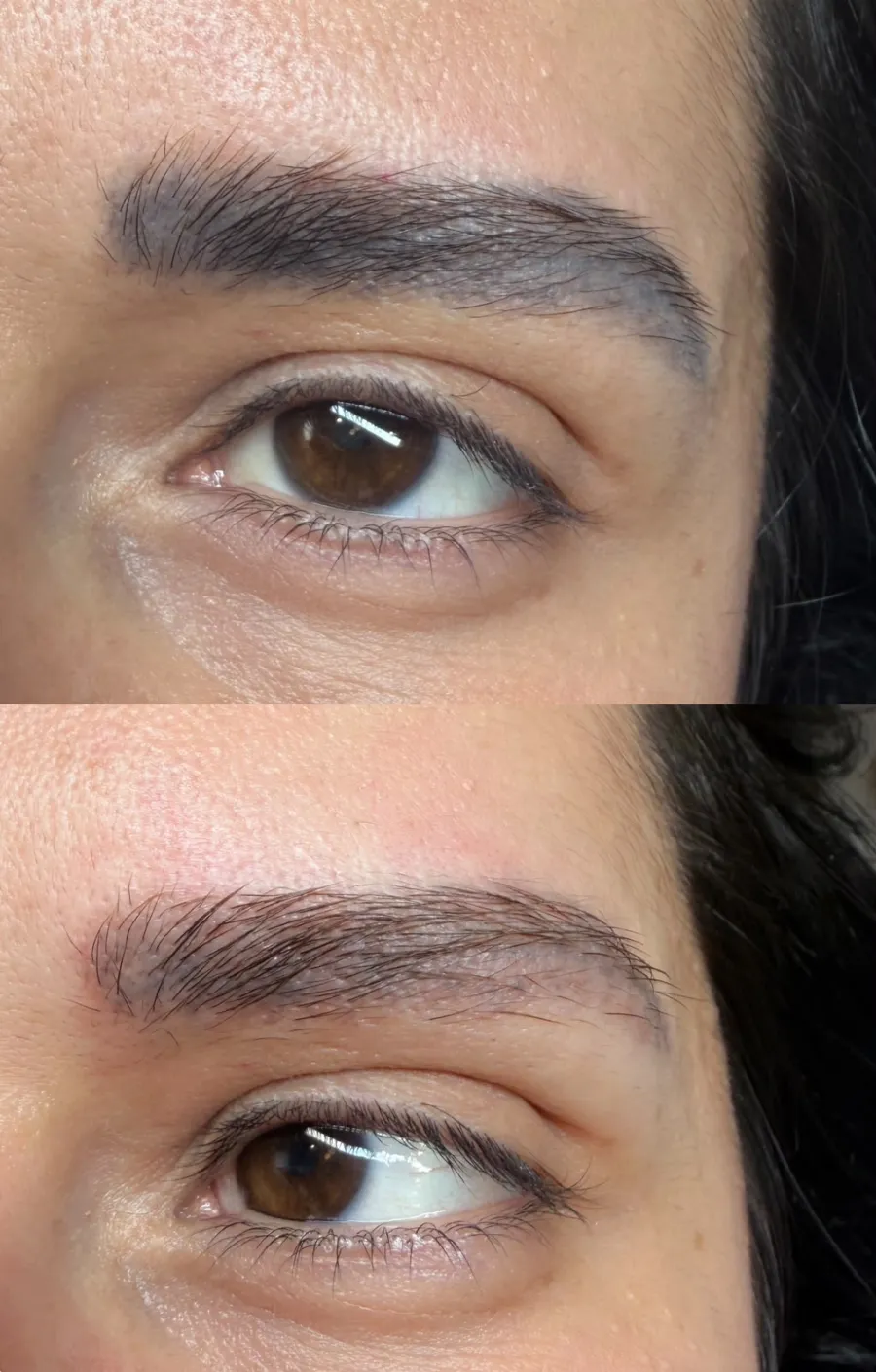 Antes e depois da remoção de micropigmentação de sobrancelha: pigmento azulado removido, fios preservados