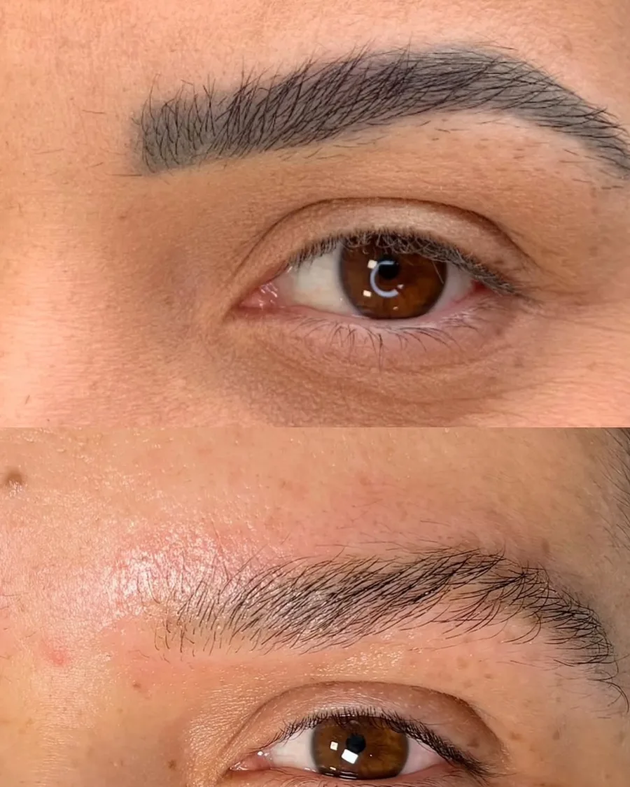 Antes e depois da remoção de micropigmentação de sobrancelha: acima, o contorno escuro marcado; abaixo, a sobrancelha com aspecto natural