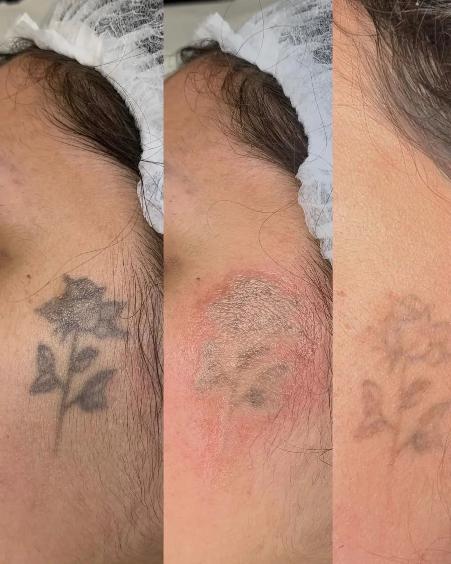 Remoção de tatuagem de flor no ombro em três etapas: à esquerda, o desenho escuro original; ao centro, a pele logo após a sessão; à direita, o pigmento já bastante clareado