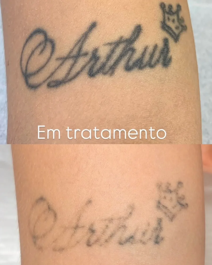 Remoção de tatuagem de nome no antebraço em tratamento: acima, o traço preto sólido; abaixo, o desenho já bem mais claro